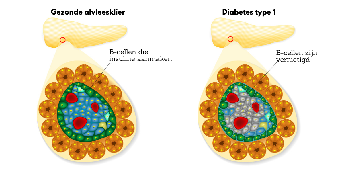 Diabetes type 1 alvleesklier